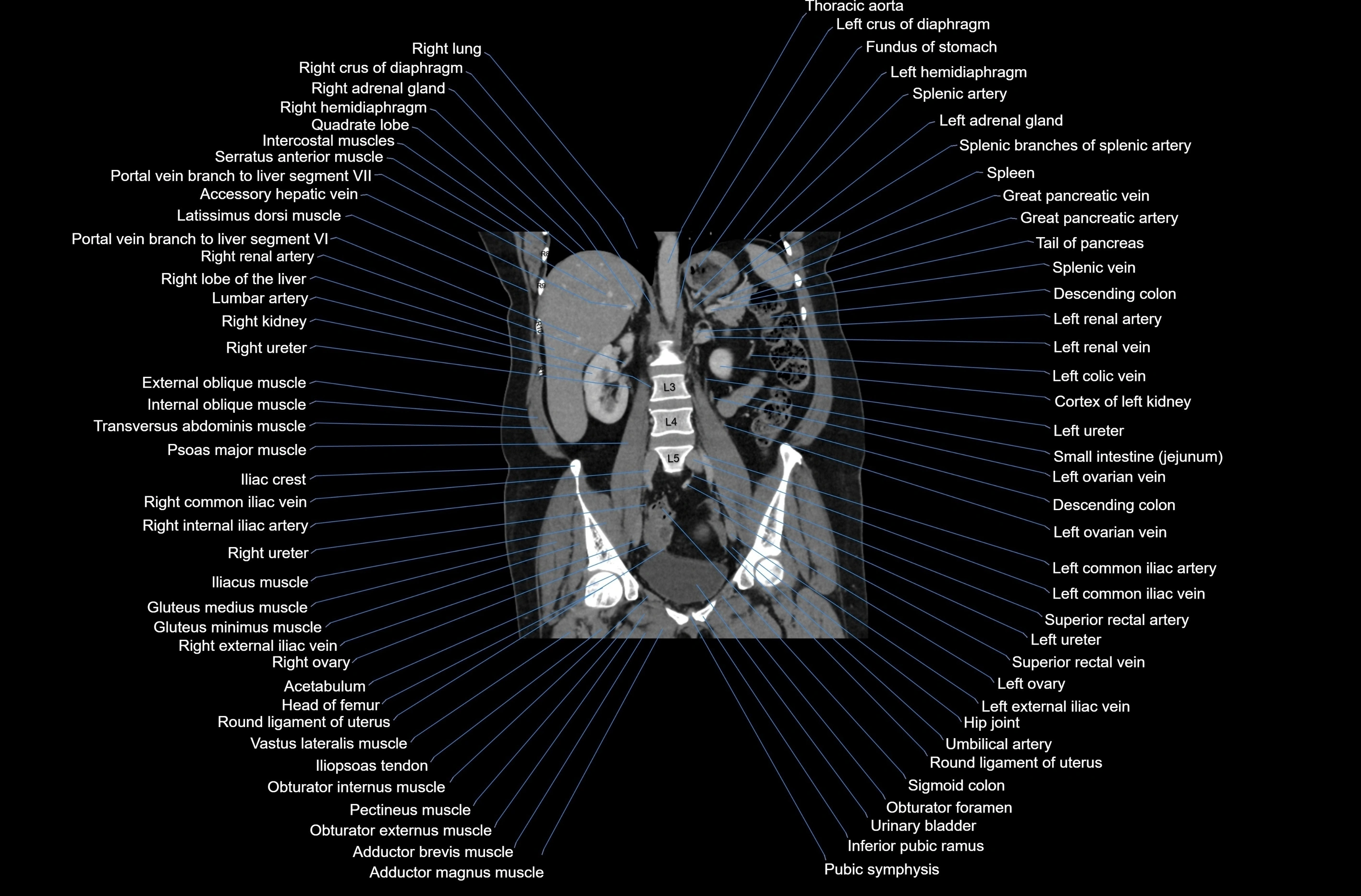 CT abdomen coronal cross sectional anatomy labelled radiology image-00050.webp